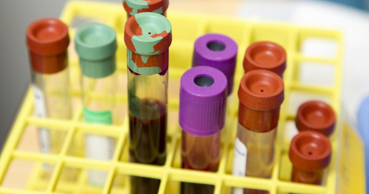 Urinalysis: what the test shows and why it matters for athletes